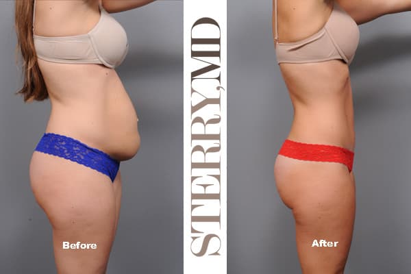 Tummy Tuck Before and After Pictures Case 16