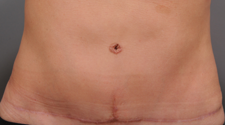 What You Need to Know About Tummy Tuck Scarring