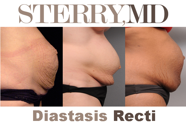 Tightening Your Tummy With Diastasis Recti Repair (Before and