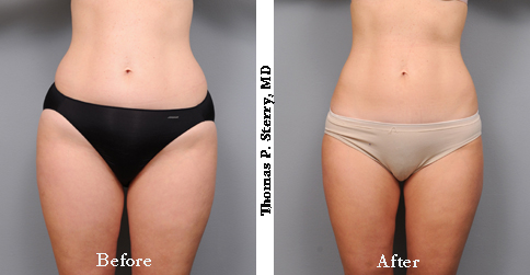 https://www.drsterry.com/content/uploads/2021/04/Liposuction-Hips-Before-and-After-AP.jpg