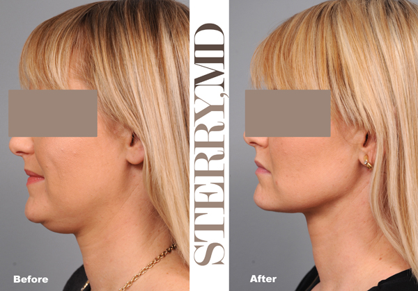 Liposuction, Neck Lift, or Nonsurgical Neck Lift: What's Best for