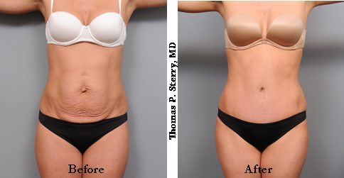 Body Contouring and Skin Removal Surgery