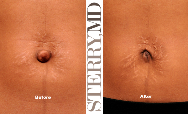 Your Belly Button After Tummy Tuck Surgery