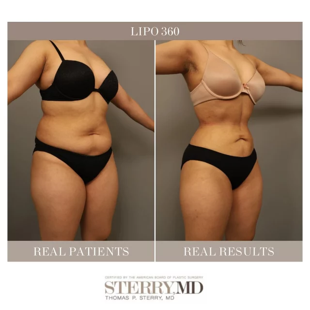 If you’re struggling with stubborn fat around your midsection that won’t budge despite diet and exercise, Lipo 360 could be the solution you’ve been looking for. 
.
This procedure targets the entire circumference of your torso, including the abdomen, waistline, back and flanks, giving you a more sculpted, toned appearance. 
.
Unlike traditional liposuction, which focuses on just one area, Lipo 360 addresses every angle for a smoother, more contoured shape. Using advanced liposuction techniques, the procedure gently removes excess fat to help you achieve the body you’ve always wanted. 
.
.
.
.
.
#drsterry #lipo360nyc #lipo360 #360lipo #360liposuction #360lipobodymakeovers #boardcertifiedplasticsurgeon #muffintop #muffintopbegone #fatlosstransformation