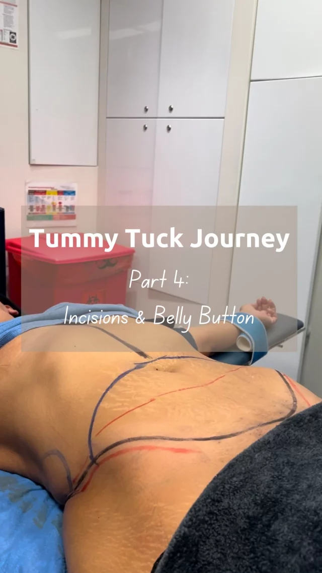 Part 4: Tummy Tuck Incisions & Belly Button

Stay tuned for the next video featuring other aspects of the tummy tuck procedure, such as the abdominal muscle tightening and TAP block used for pain management 😊✨

Don’t forget to like and follow for more of this mother’s tummy tuck journey — I will be taking you through the consultation and surgery day to recovery, sharing everything you need to know! 
.
.
.
#plasticsurgery #tummytuck #surgery #nyc #abdominoplasty #mommymakeover